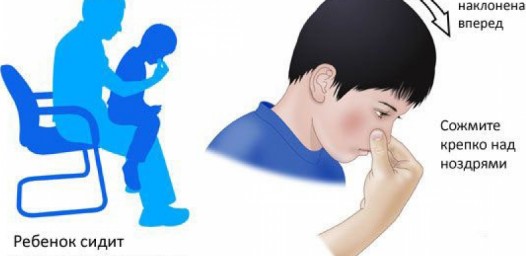 Носовое кровотечение