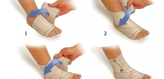 Растяжение связок